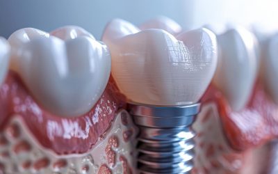 Dental Implants in Indore: A Permanent Solution for Missing Teeth